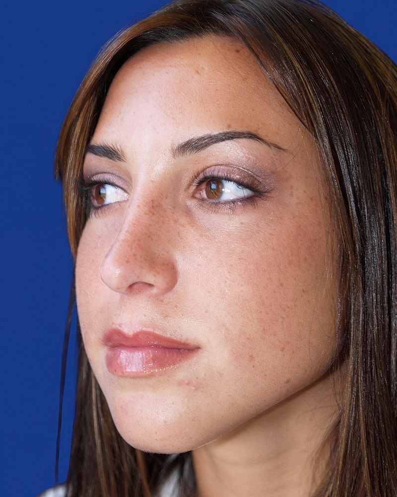 Rhinoplasty Before & After