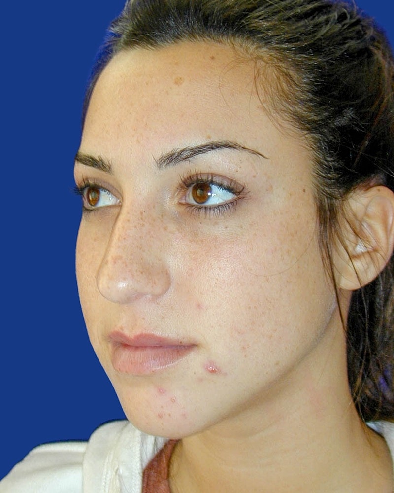 Rhinoplasty Before & After