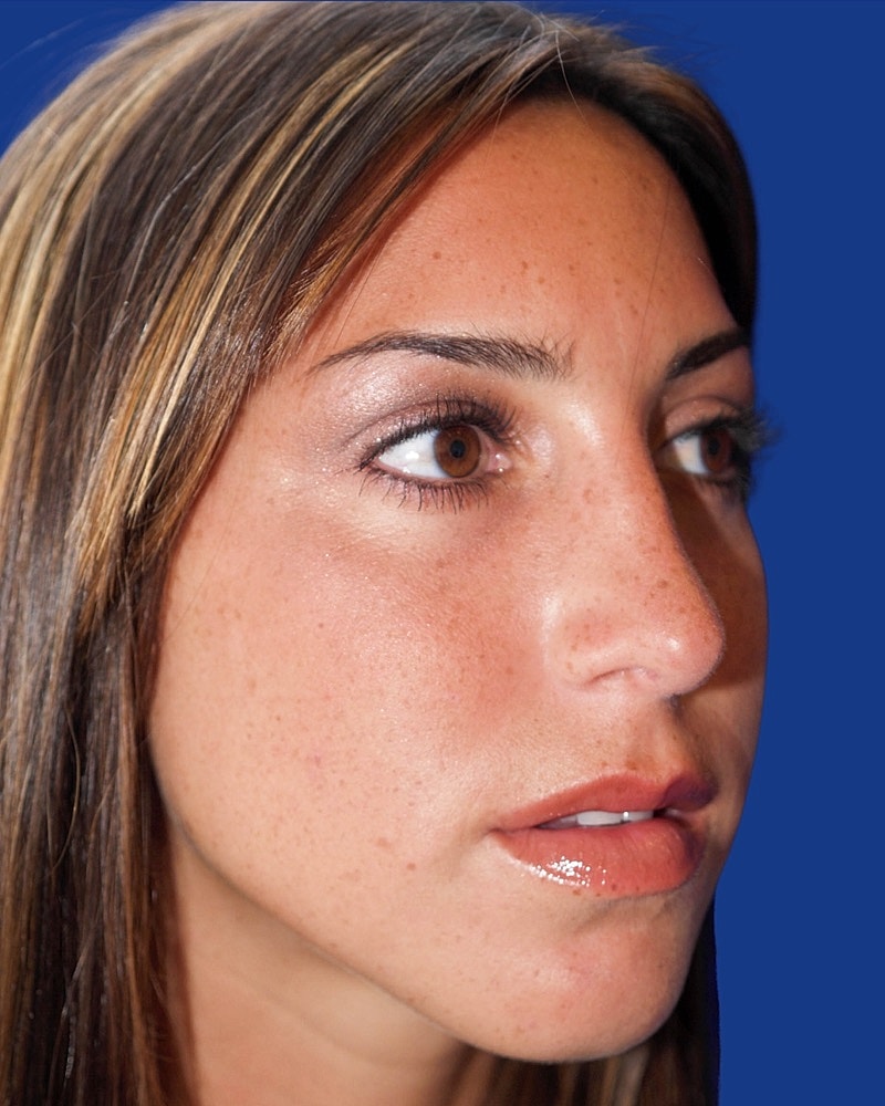 Rhinoplasty Before & After