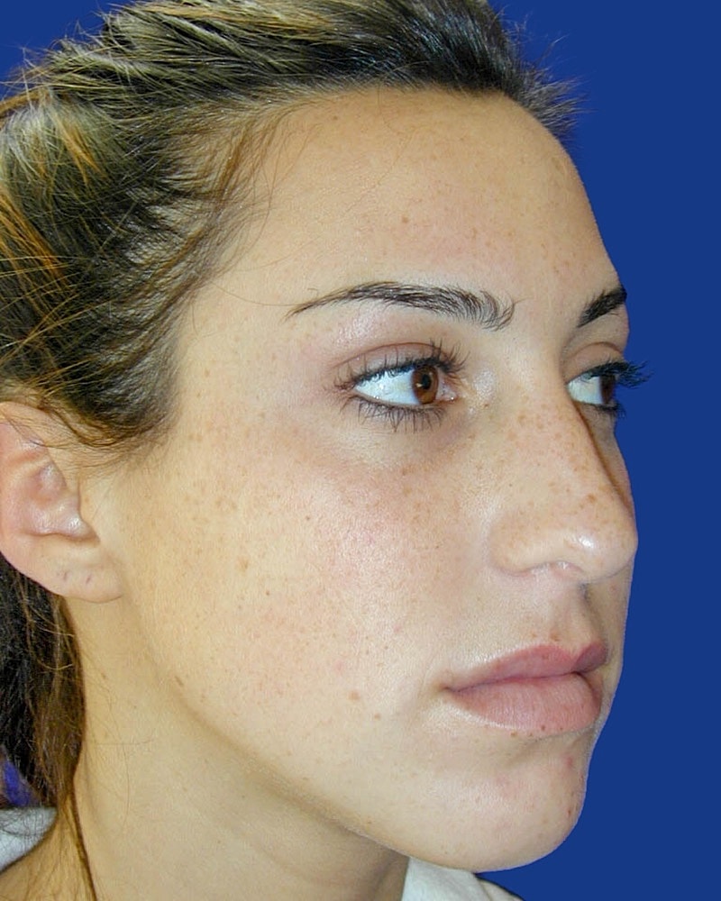 Rhinoplasty Before & After
