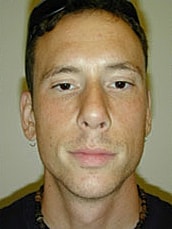 Rhinoplasty Before & After