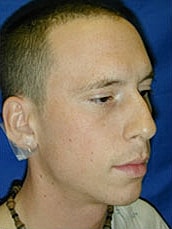 Rhinoplasty Before & After