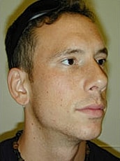 Rhinoplasty Before & After