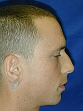 Rhinoplasty Before & After