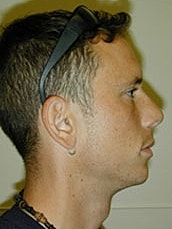 Rhinoplasty Before & After