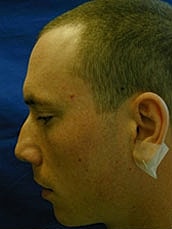 Rhinoplasty Before & After