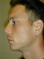 Rhinoplasty Before & After