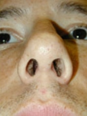 Rhinoplasty Before & After