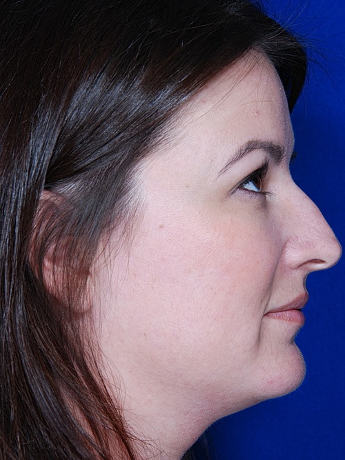 Rhinoplasty Before & After