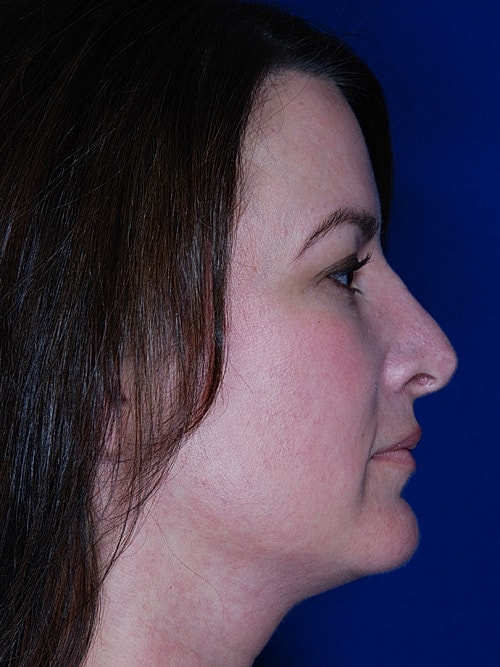 Rhinoplasty Before & After