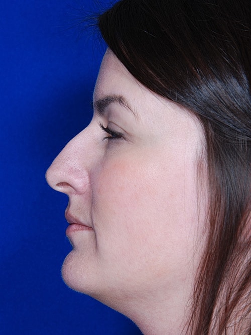 Rhinoplasty Before & After