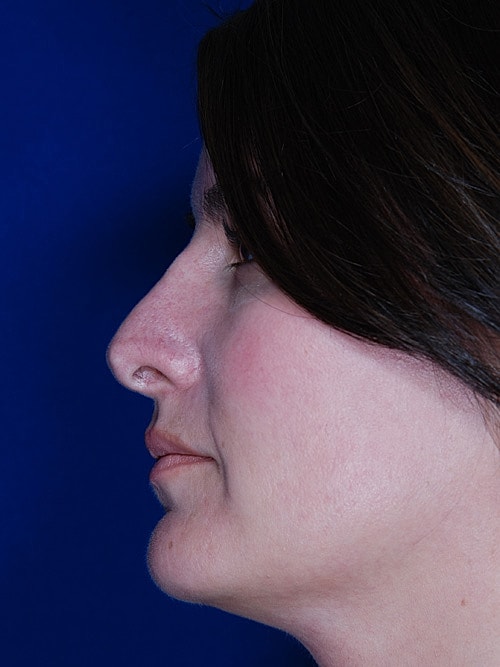 Rhinoplasty Before & After