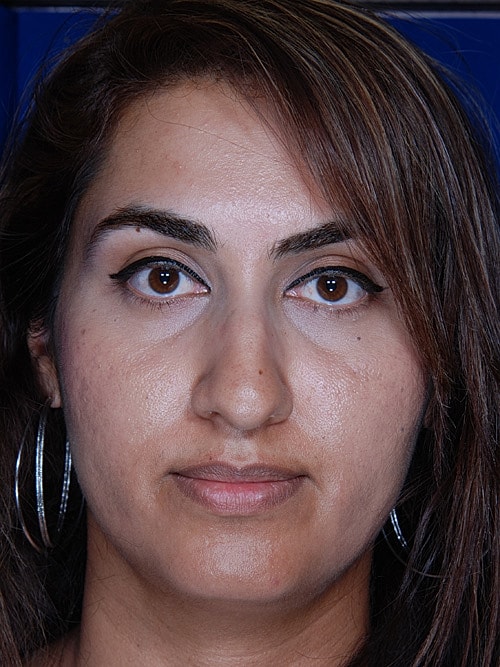 Rhinoplasty Before & After