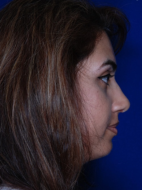 Rhinoplasty Before & After