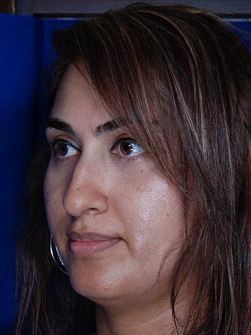 Rhinoplasty Before & After