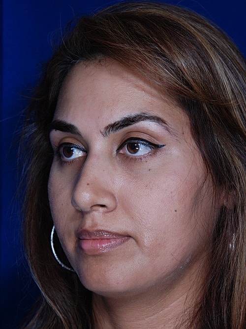 Rhinoplasty Before & After