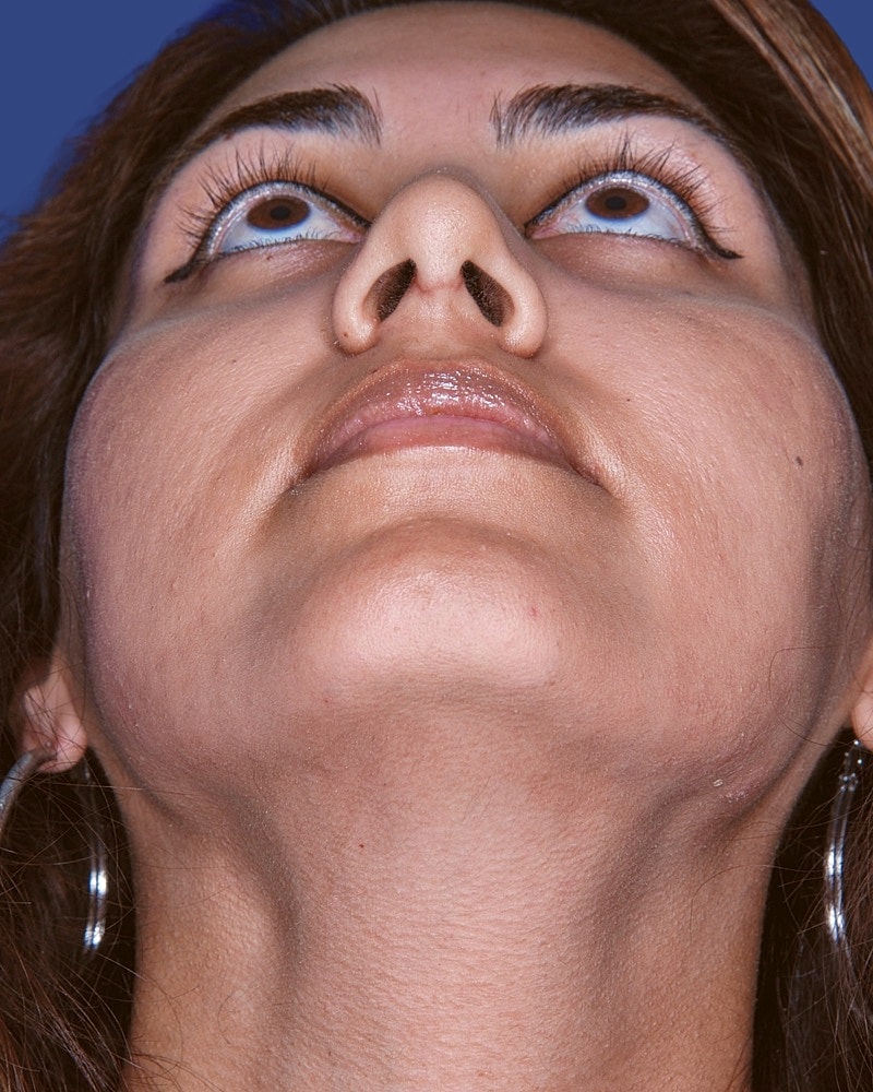 Rhinoplasty Before & After