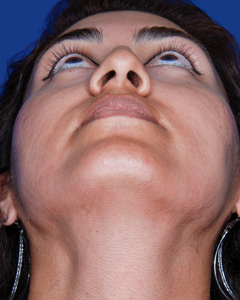 Rhinoplasty Before & After