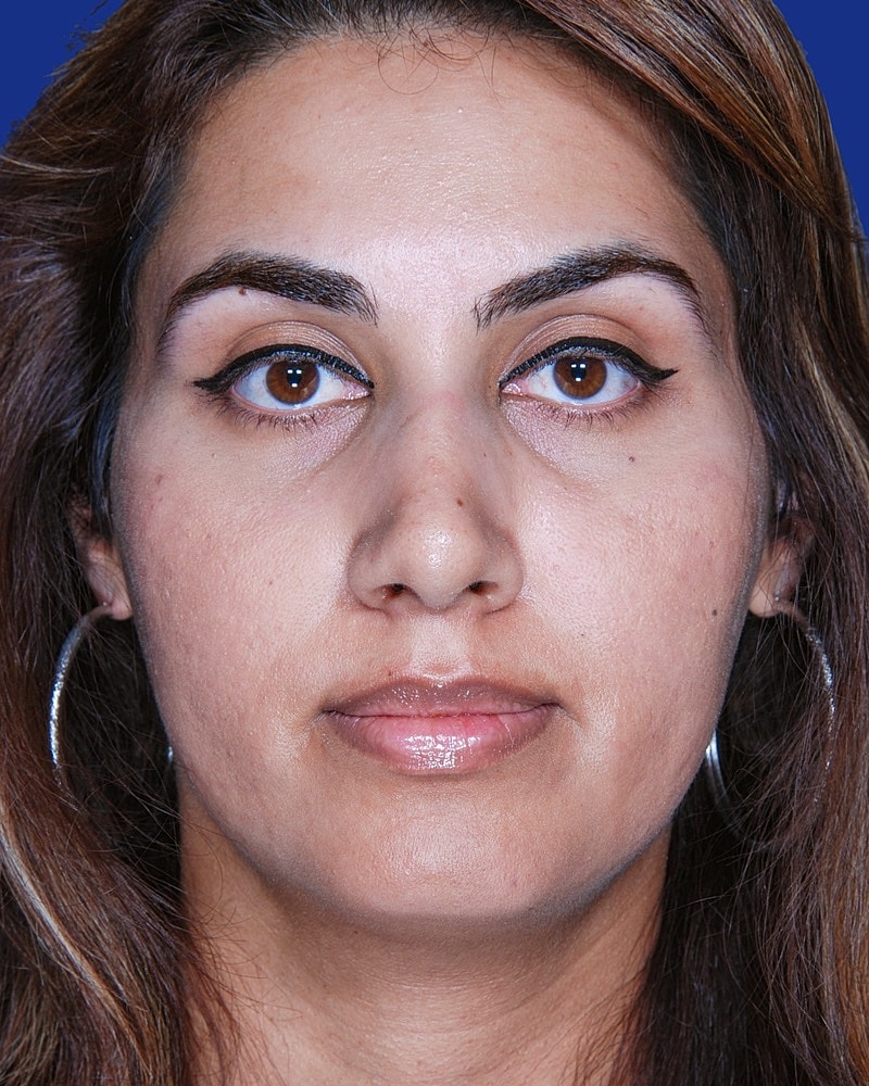 Rhinoplasty Before & After