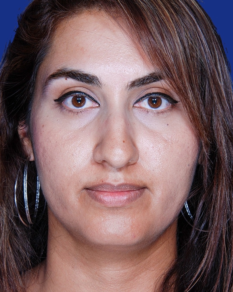 Rhinoplasty Before & After