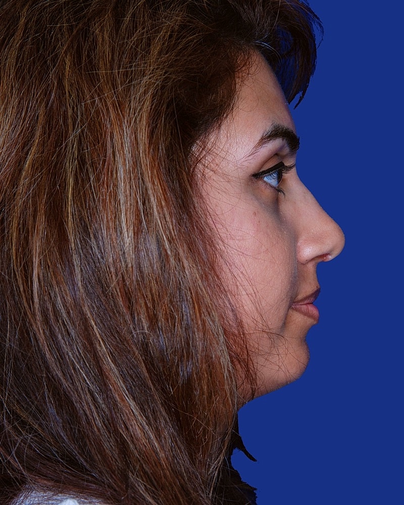 Rhinoplasty Before & After