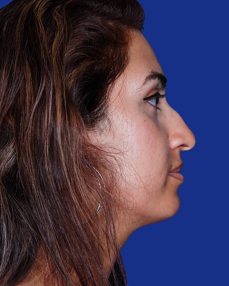 Rhinoplasty Before & After
