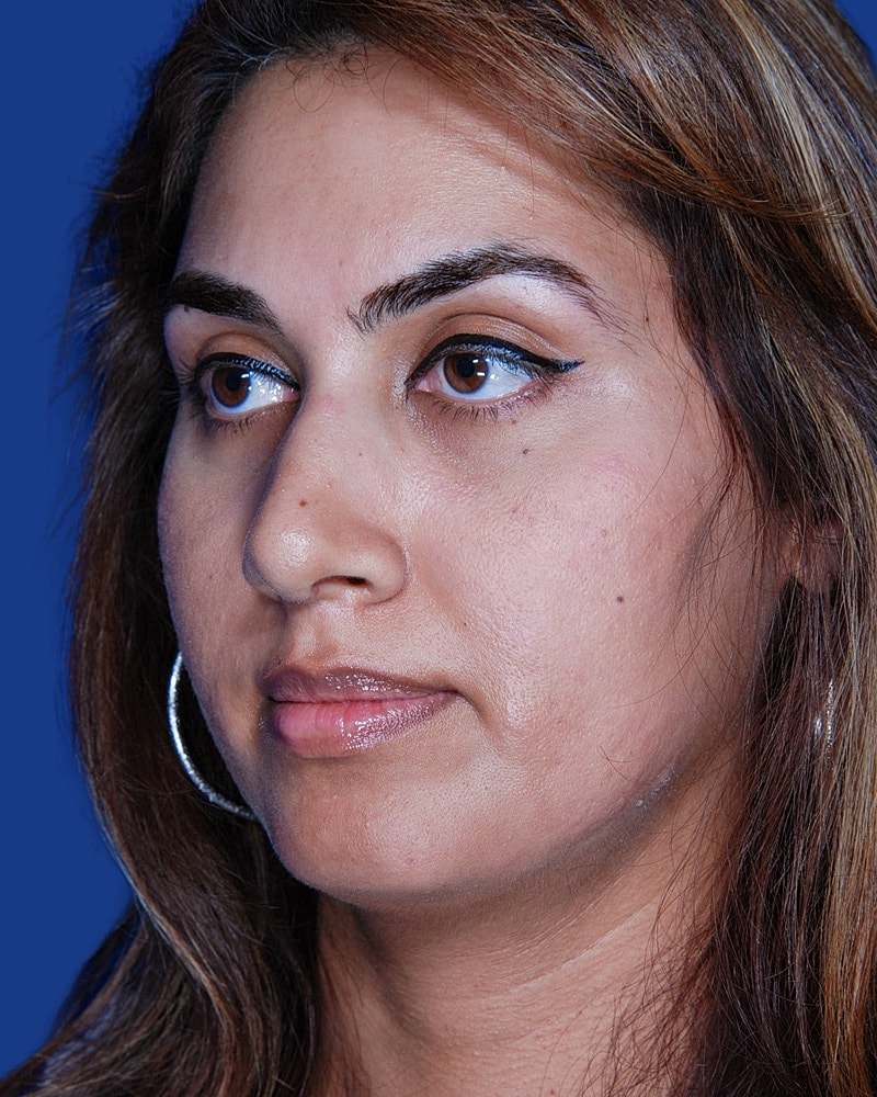 Rhinoplasty Before & After