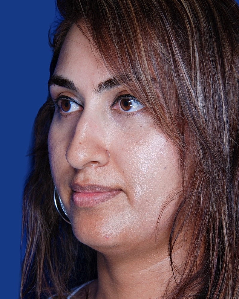 Rhinoplasty Before & After