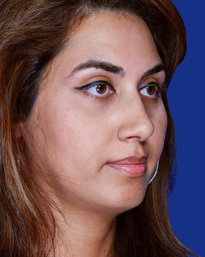 Rhinoplasty Before & After