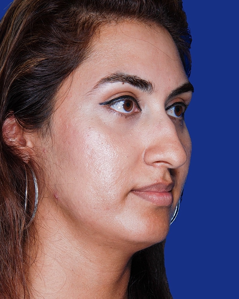 Rhinoplasty Before & After