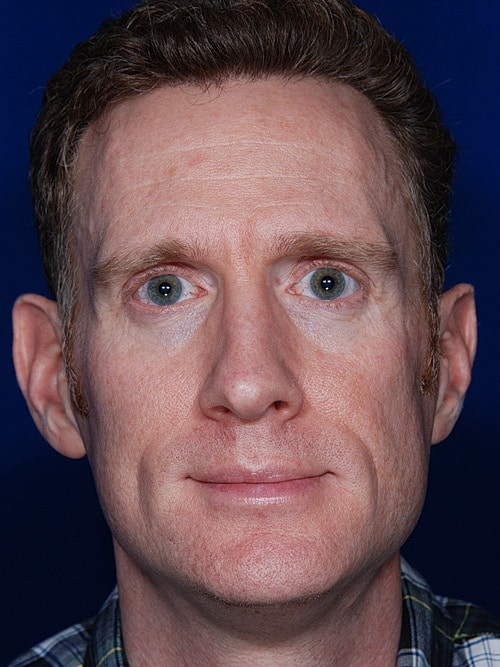 Rhinoplasty Before & After