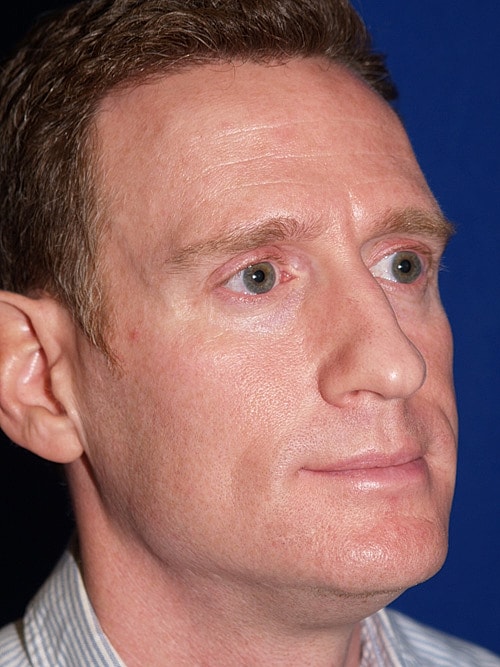 Rhinoplasty Before & After