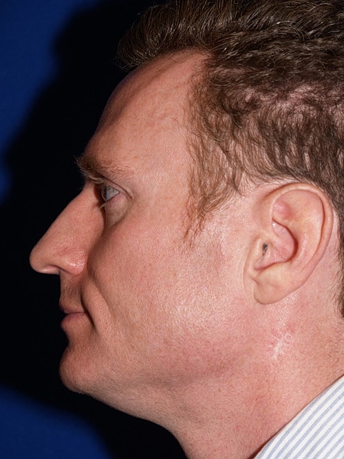 Rhinoplasty Before & After