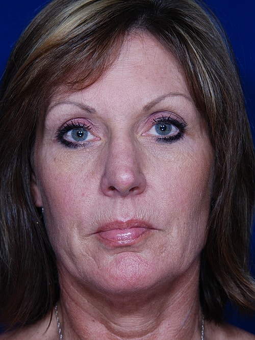 Rhinoplasty Before & After