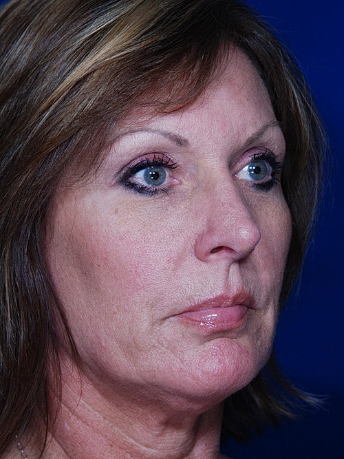 Rhinoplasty Before & After