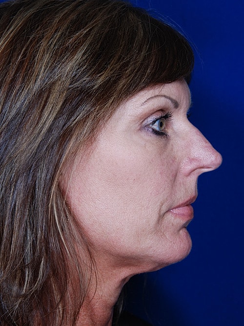 Rhinoplasty Before & After