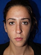 Rhinoplasty Before & After