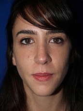 Rhinoplasty Before & After