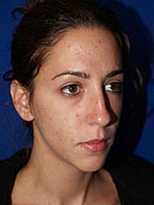 Rhinoplasty Before & After