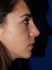 Rhinoplasty Before & After