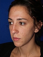 Rhinoplasty Before & After