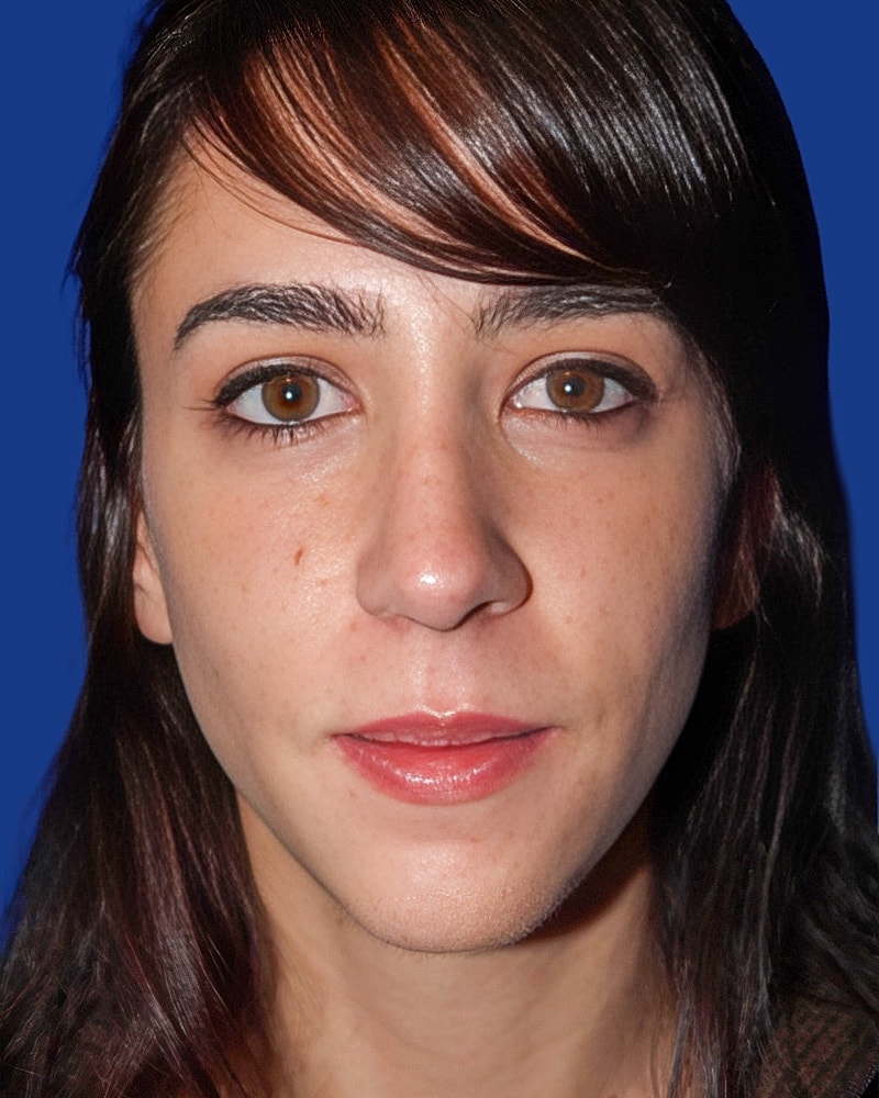 Rhinoplasty Before & After