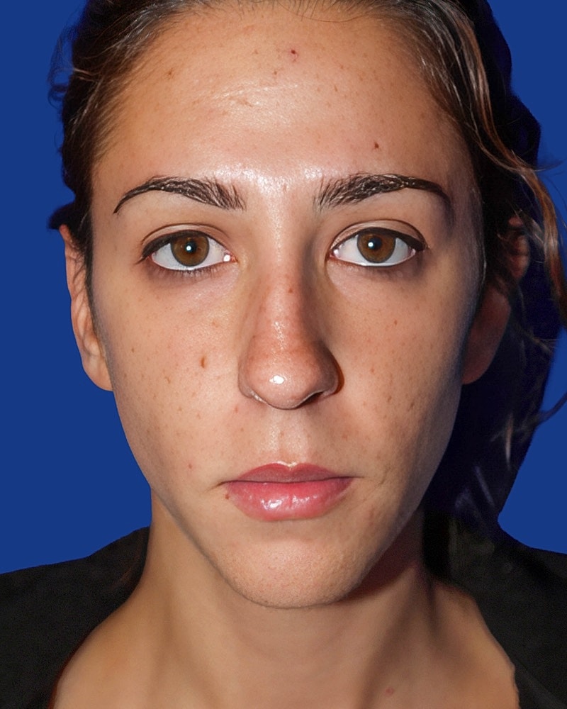 Rhinoplasty Before & After