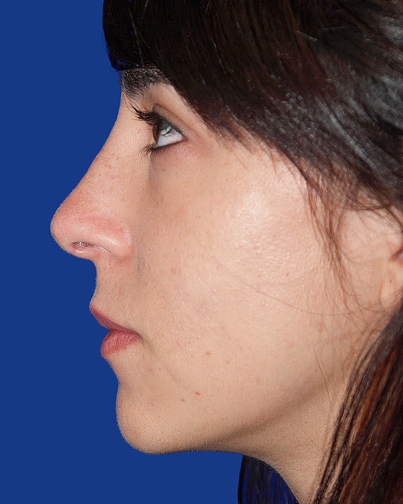 Rhinoplasty Before & After