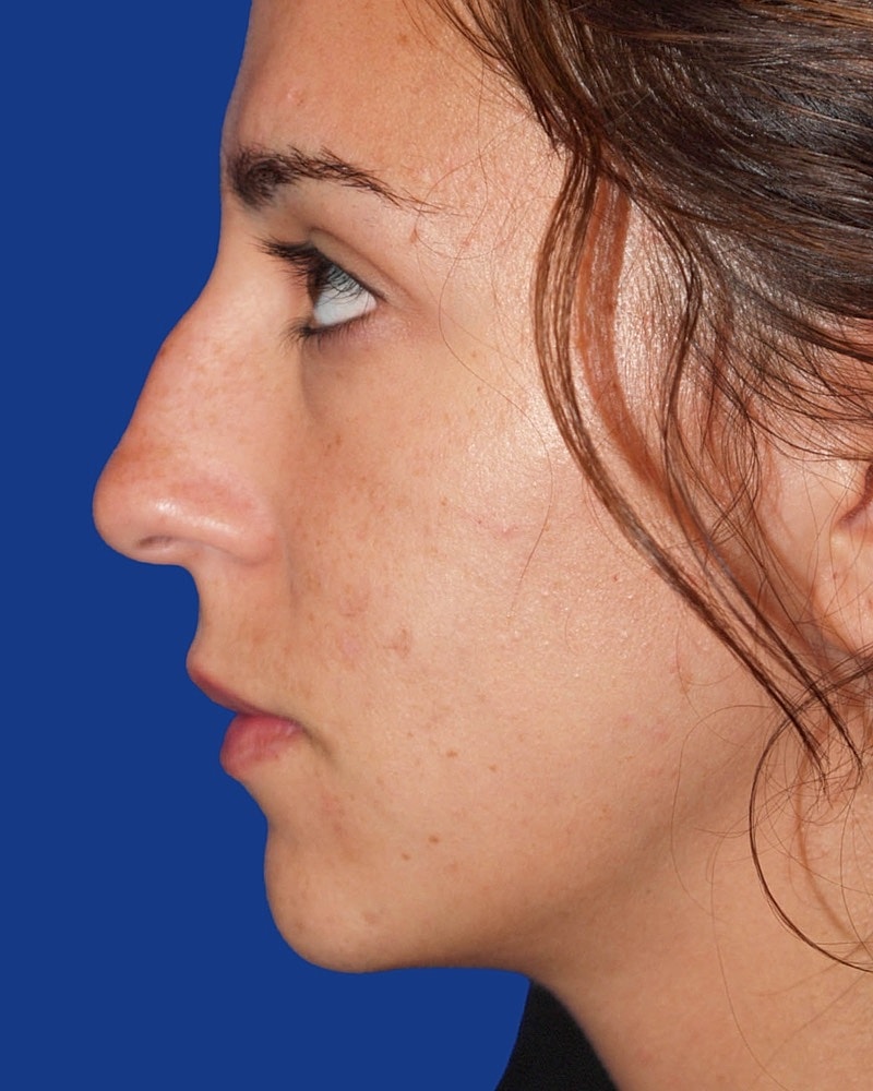 Rhinoplasty Before & After