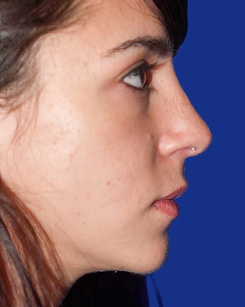 Rhinoplasty Before & After