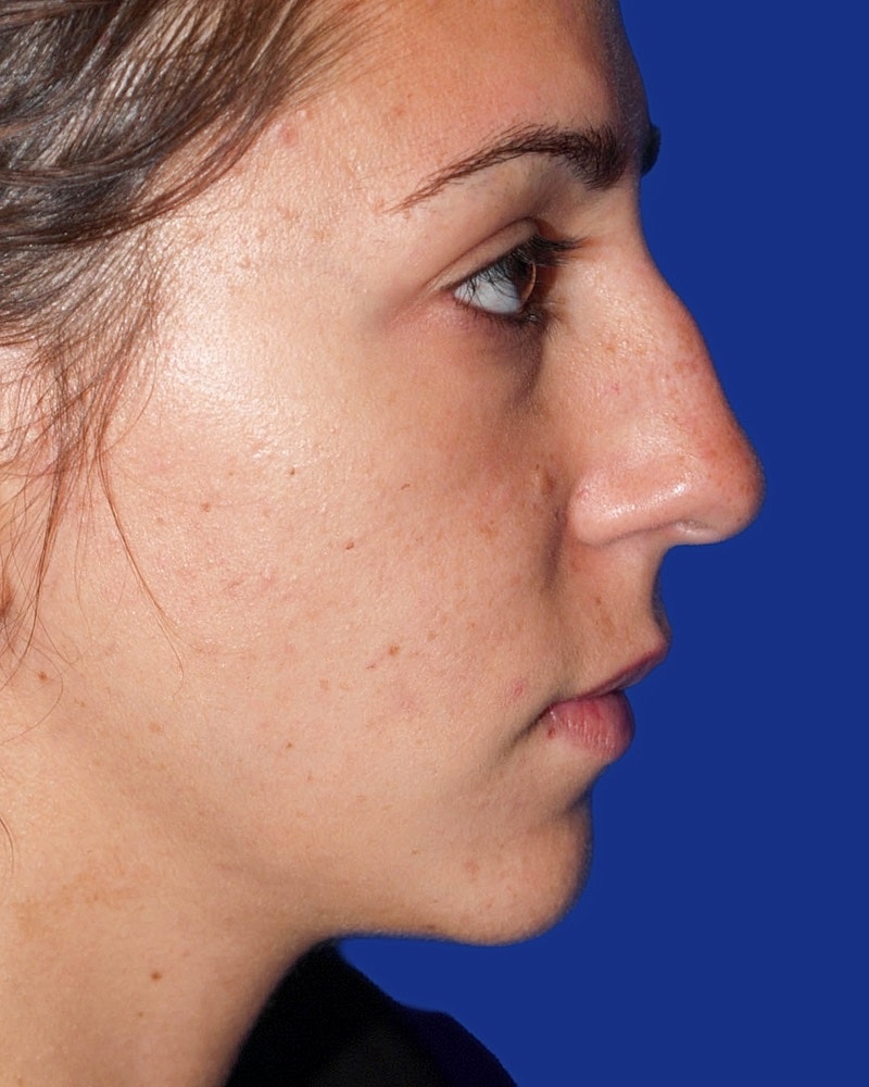 Rhinoplasty Before & After
