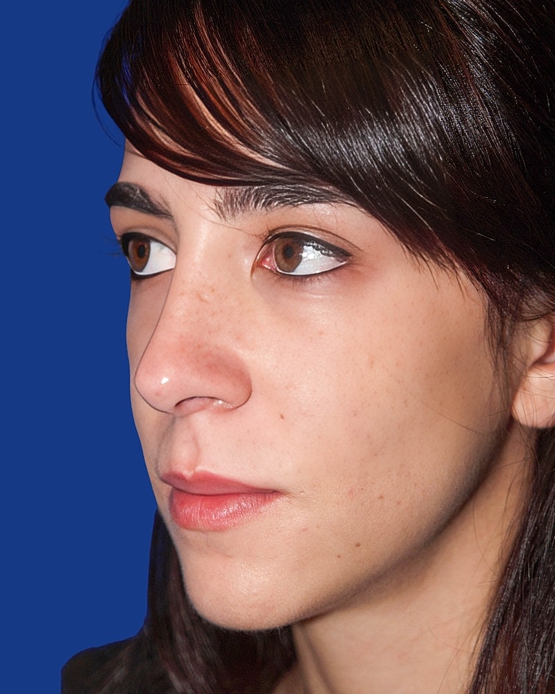 Rhinoplasty Before & After