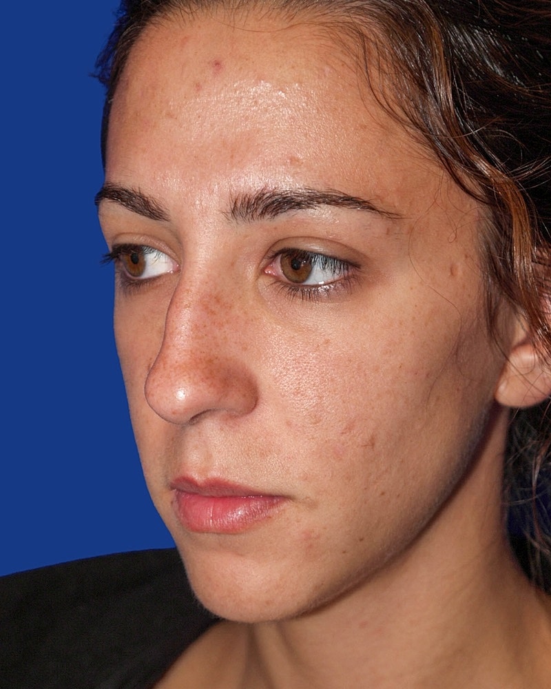 Rhinoplasty Before & After