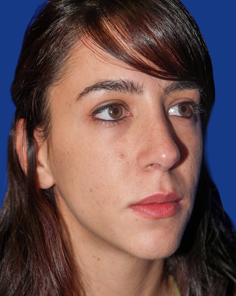 Rhinoplasty Before & After